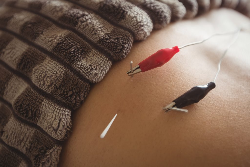 tens electroestimulacion